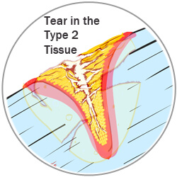 Tear in the Type 2 Tissue, After the Wound Started to Heal