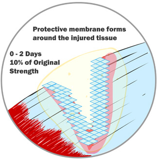 A Protective Membrane Forms Around the Injured Tissue