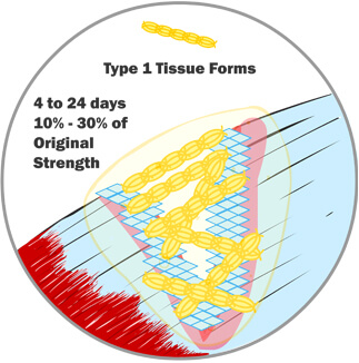 Type 1 Tissue Begins to Form