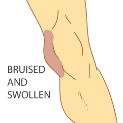 Symptoms of a Re-Injured MCL Symptoms of a Re-Injured MCL