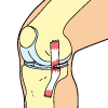 Torn MCL Injury - Grade 2