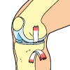 Torn MCL Injury - Grade 3
