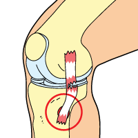 Knee Bursitis