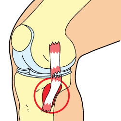 Knee Bursitis Knee Bursitis