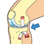 Complete MCL Tears May Require Surgery Complete MCL Tears May Require Surgery
