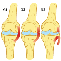Time Frame for MCL Injury Time Frame for MCL Injury